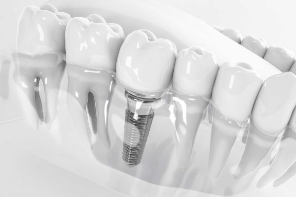Implantes Dentales